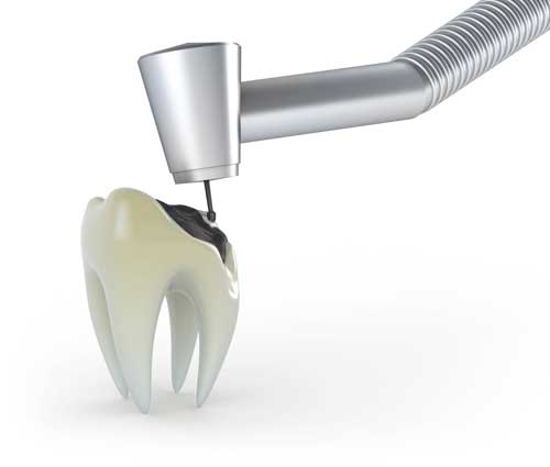 An illustration of a tooth filling