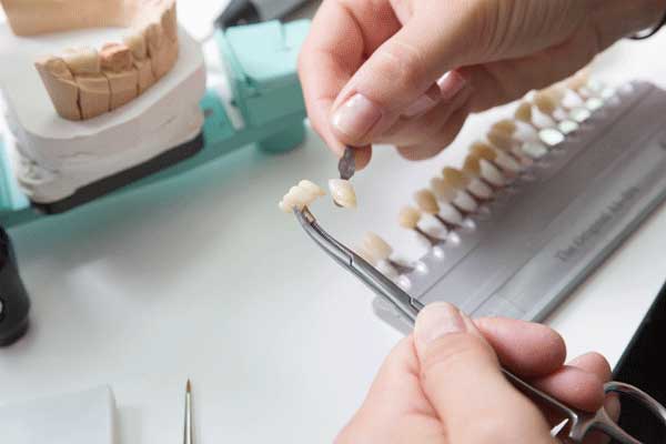A dental technician in a process of making veneers to have a teeth bonded