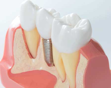 A dental implant between 2 healthy teeth