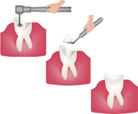 A step by step illustration of a tooth filling