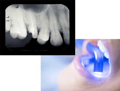 Top - an xray image of a teeth, Bottom - An open mouth with Laser fluorescence Cavity Detection Aids
