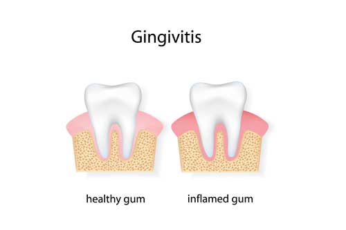 An illustration that shows gangivitis: left - a healthy gum, right - an inflamed gum
