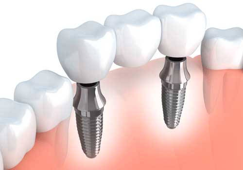 Dental Implants Santa Ana