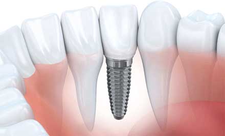 A set of teeth focusing on the single tooth implant that shows it has titanium implant base