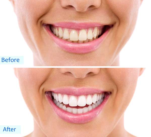 A before and after shots of a woman smiling. The before photo shows that she has yellow-ish teeth. In the after photo, her teeth is pearl white and she's smiling more widely
