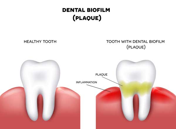 A comparison between a healthy tooth (left) and a tooth with a plaque (right)