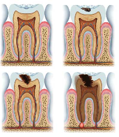 An illustration on how a tooth decay: upper left - healthy tooth, upper right - a small tooth decay, lower left- a decay almost reach the tooth, lower right - the decay has reached the root