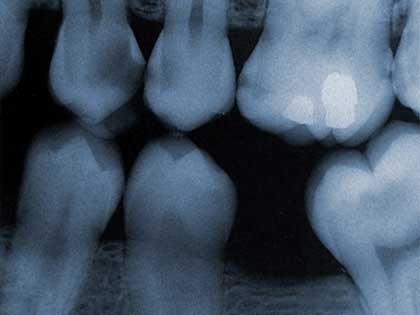 An xray image showing one missing tooth in the lower jaw