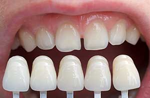 A set of veneers being compared to the upper jaw teeth
