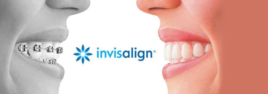 A mirror image of a side profile image of a mout smiling with a logo of invisaligh in between. Left - a black and white mouth smiling with braces, Right - A colored photo of a side profile of a mouth smiling showing white aligned teeth