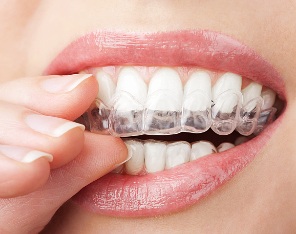 Teeth Whitening - Adams Dental