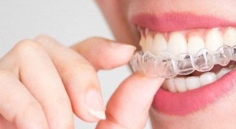 Five important benefits of having straight adult teeth