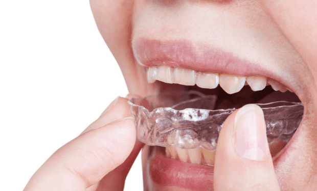 Straightening your teeth shouldn’t be a daunting task forcing you to be unhappy with your uneven smile. At Smile Brite Dental we offer a virtually painless solution with Invisalign treatments.