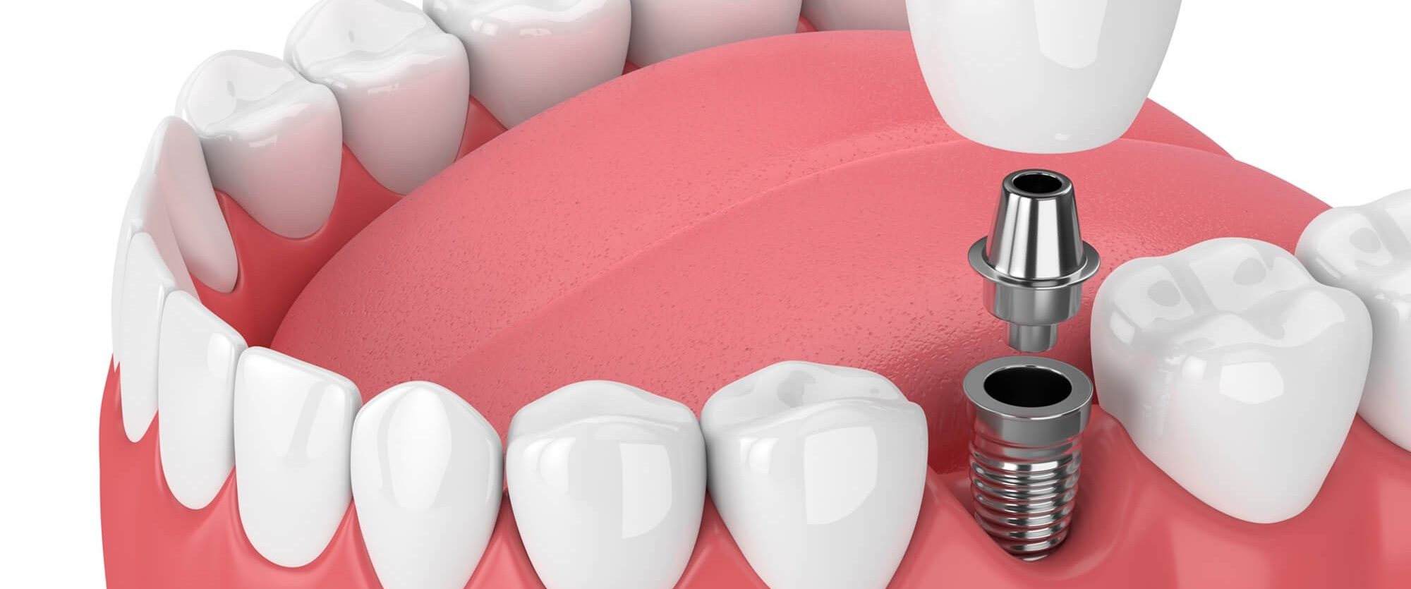 Five important benefits of having straight adult teeth
