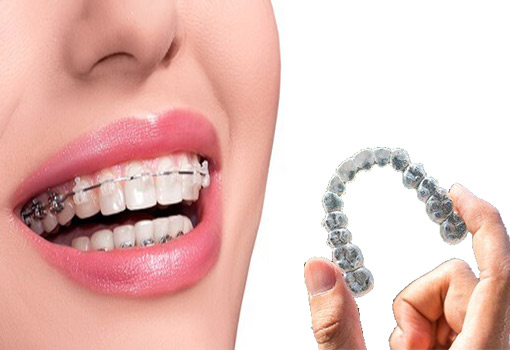 Which will work better Braces or Invisalign