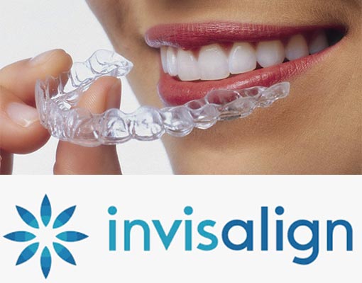 Invisalign is Low maintenance, easy removal for cleaning