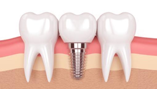Best Dental Implant Dentist in Anaheim, CA