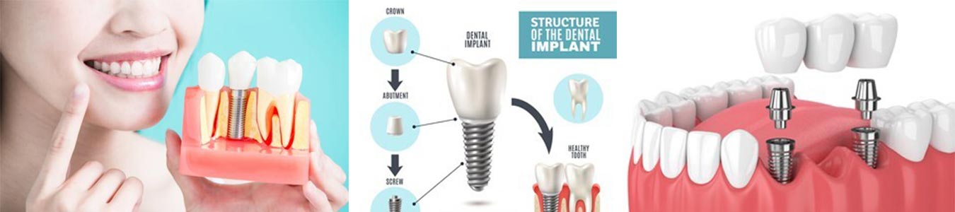 Dental-Implant-Dentist-in-Anaheim-Hills-CA