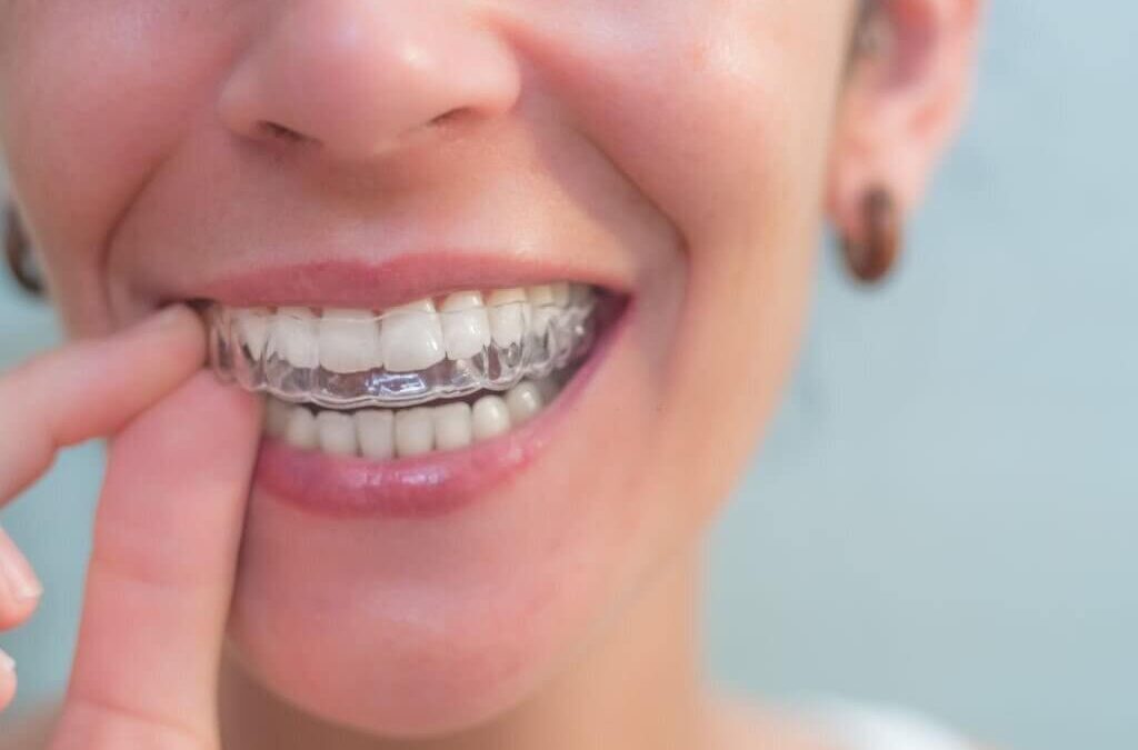People Choose Invisalign Over Traditional Braces
