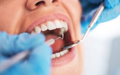 Is Getting Your Teeth Whitened At A Dentist Better Than Doing It Yourself?