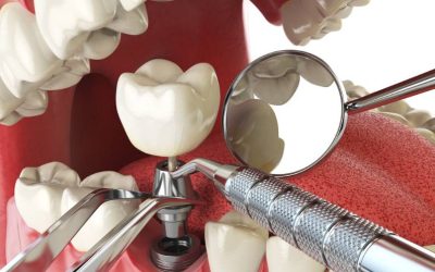 What Is The Difference Between Full Arch Dental Implants And Denture Supported Implants?