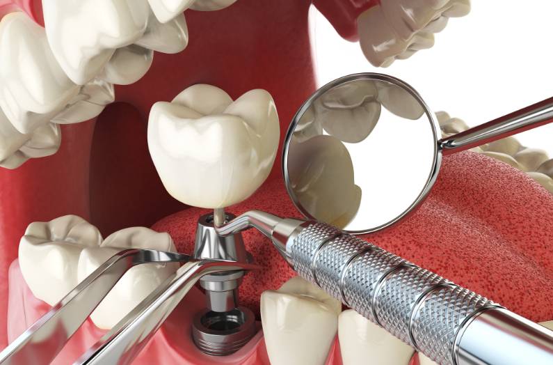 Dental Implantation Concept