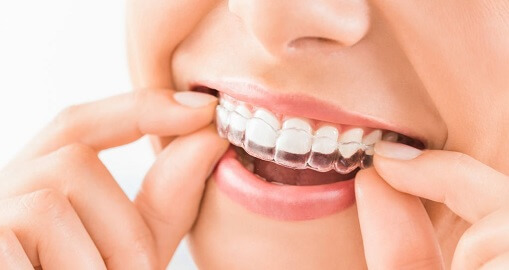 Best Place for Invisalign Service in Anaheim, CA