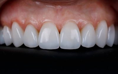 Porcelain Veneers: An Amazing Smile Makeover Made Easy