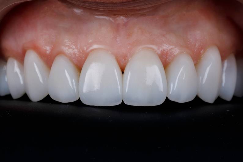 Porcelain Veneers: An Amazing Smile Makeover Made Easy